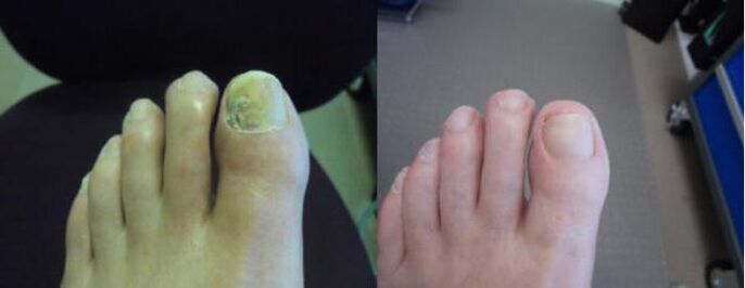 Fotos de pés antes e depois de usar o creme Zenidol