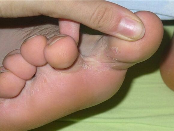 sintomas de fungos nas unhas dos pés