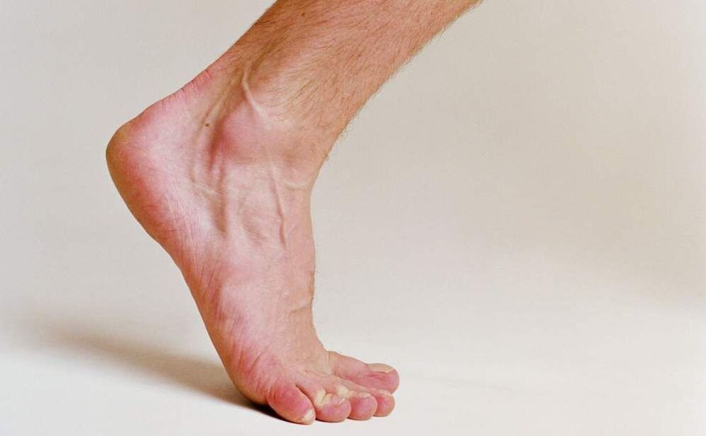 sintomas de fungos nos pés
