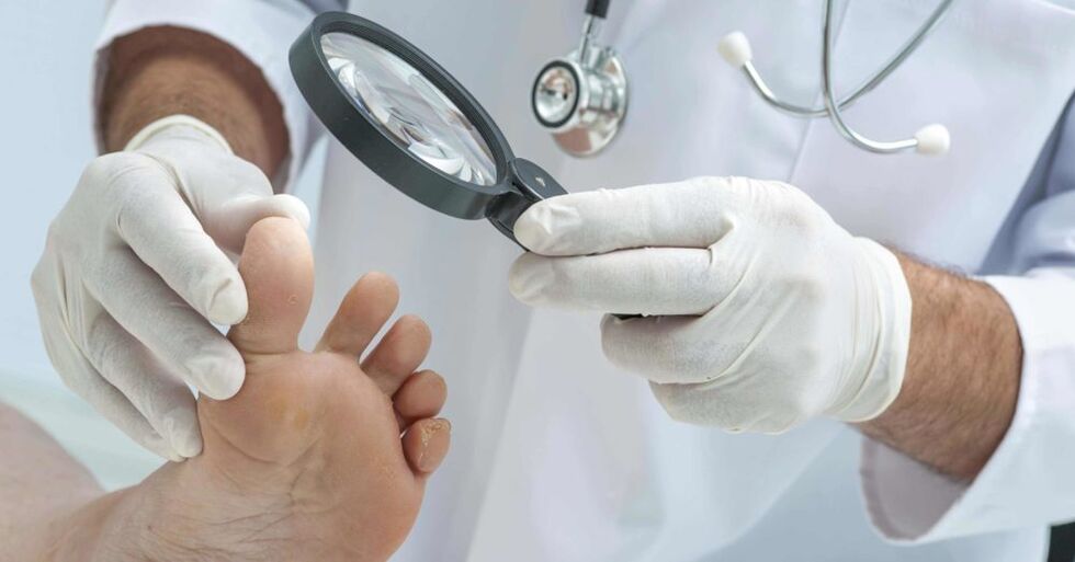 médico examina os pés com fungos