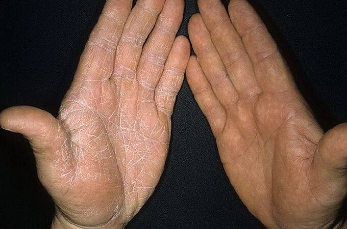 sintomas de um fungo na pele das mãos