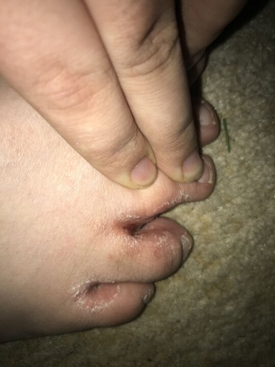 infecção de fungo do dedo do pé