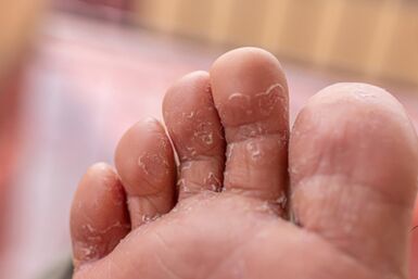 sintomas de infecções fúngicas dos dedos dos pés
