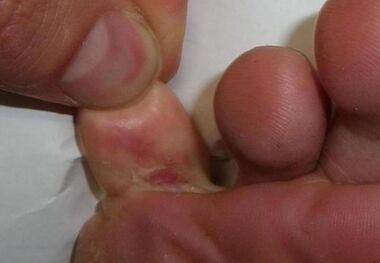 uma rachadura no dedo do pé é o resultado de uma infecção por fungo
